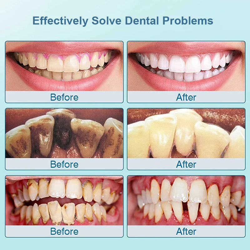 Ultrassônico Dental Removedor de Tártaro