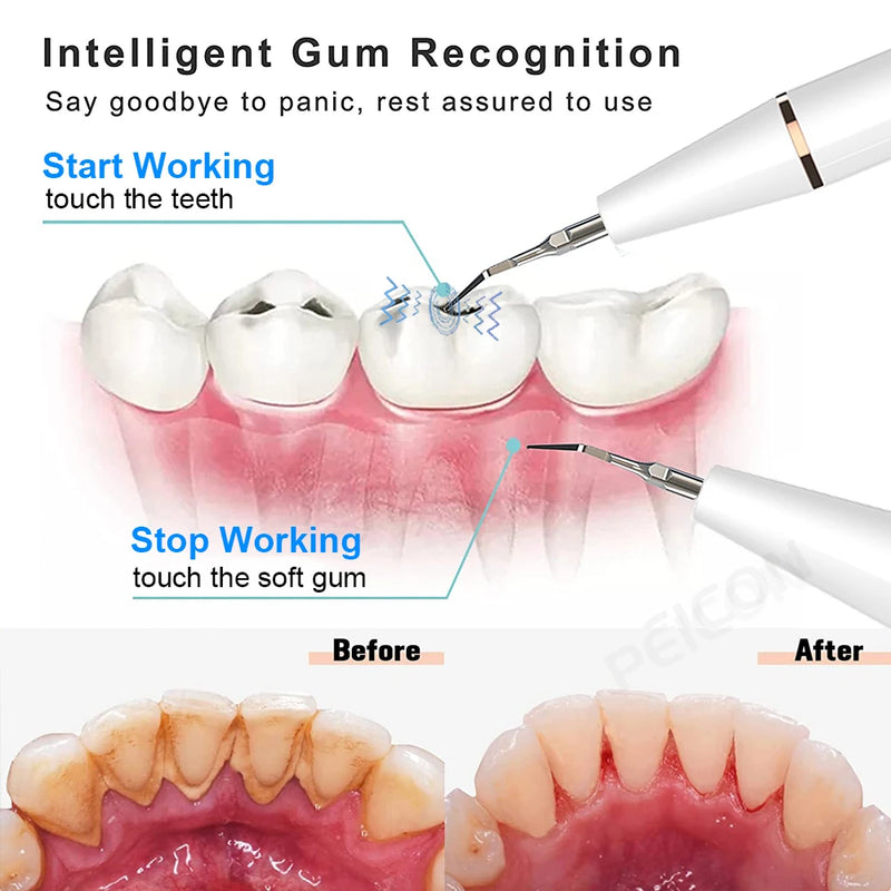 Ultrassônico Dental Removedor de Tártaro